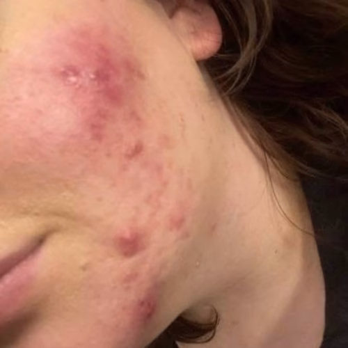 What I Did to Finally Get Rid of Acne for Good (No Fancy Products Needed)