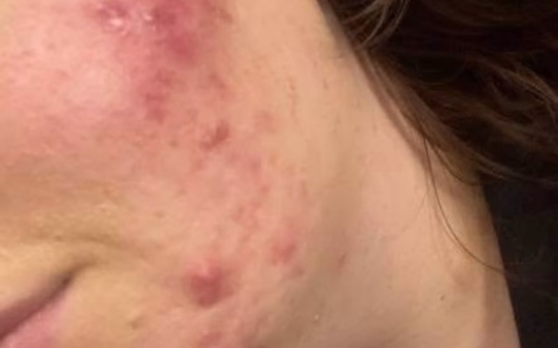 What I Did to Finally Get Rid of Acne for Good (No Fancy Products Needed)